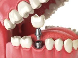 Read more about the article Dental Implant Procedure