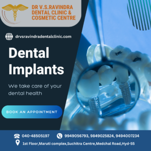 Read more about the article Dental Implants in Suchitra Hyderabad