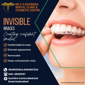 Read more about the article Invisible Braces Benefits