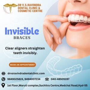 Read more about the article Best invisible braces in suchitra hyderabad