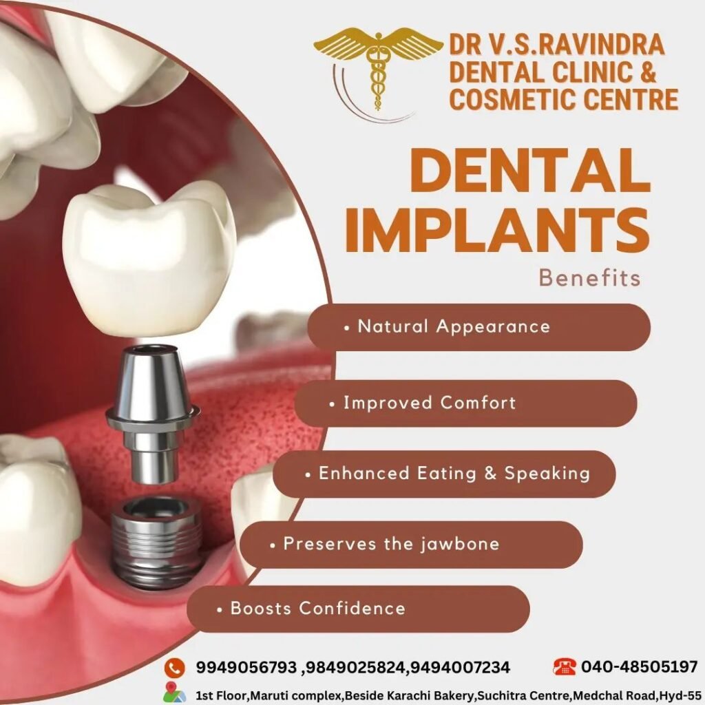 discover-the-benefits-of-all-on-4-dental-implants