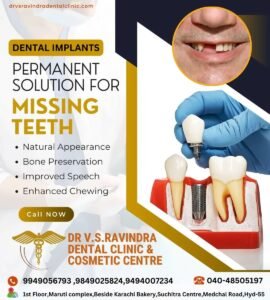 Read more about the article Benfits of Dental Implants