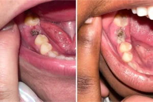 Read more about the article Dental Socket Healing
