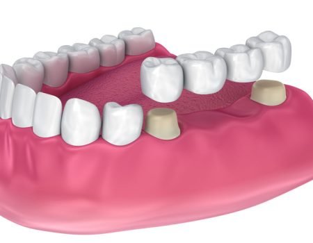 98343629 - tooth supported fixed bridge. medically accurate 3d illustration