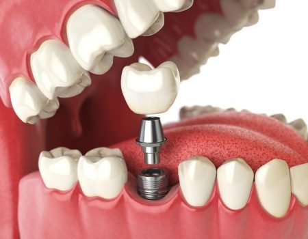 dental-implants